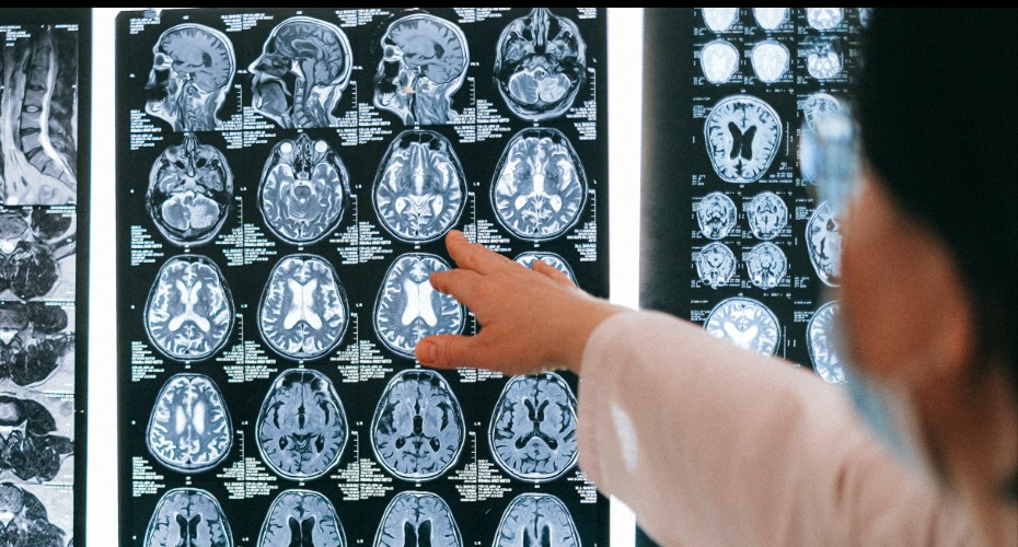 Doctor pointing to image on an MRI brain scan